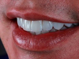 institutobernal-dr-anderson-bernal-tratamentos-lentes-de-contato-dentais-2019
